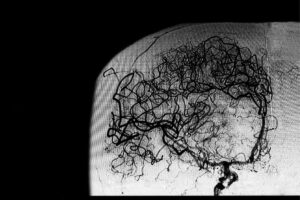patologia vascular cerebral
