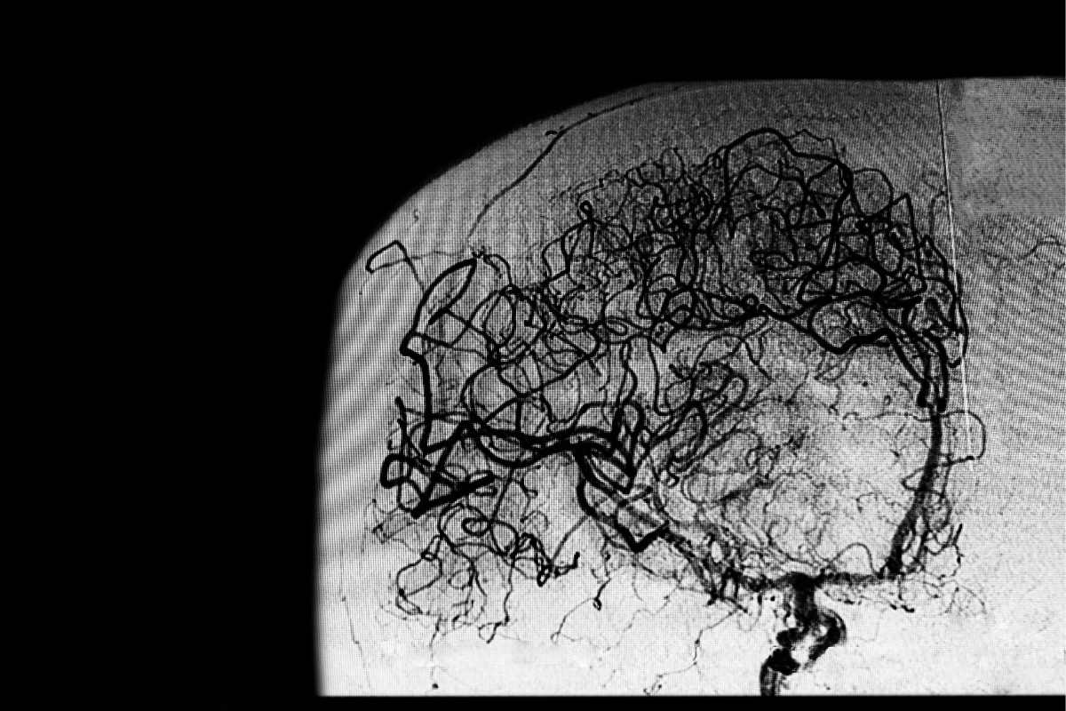 patologia vascular cerebral
