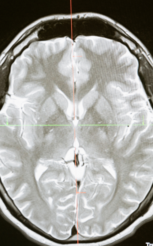 micrometástasis cerebrales