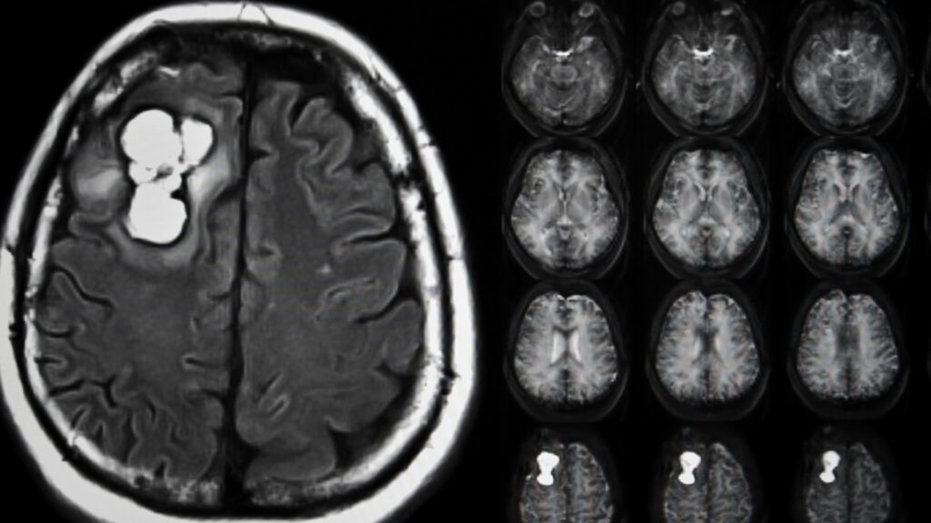 METÁSTASIS CEREBRALES